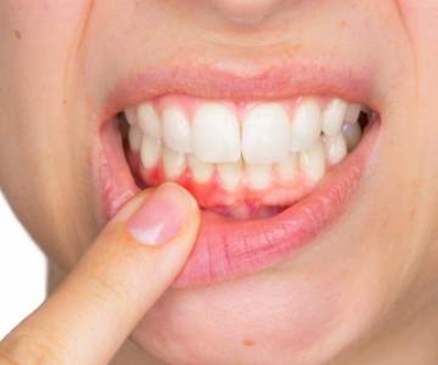 Periodoncia