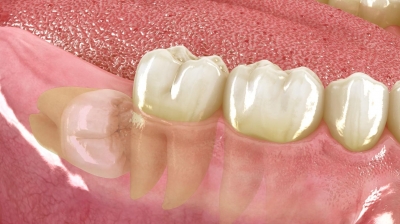 Cirug&iacute;a Dental